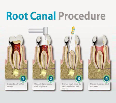 Root Canal Treatment In South Delhi | Kamal Dental Clinic